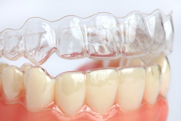 Ways That Clear Aligners Differ From Traditional Aligners